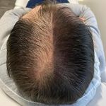 میکرواسکالپ درمان کم پشتی مو حسنی