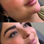 تزریق ژل و بوتاکس .انزیم