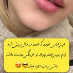 شیدینگ لب بدون درد در قم