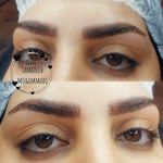 مرکز تخصصی میکروبلیدینگ فیبروز ریموو تخصصی
