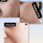 فیشیال تخصصی کلینیک زیبایی کوروش