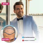 مرکز کاشت مو حسینی