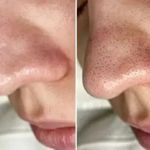 فشیال و پاکسازی تخصصی پوست