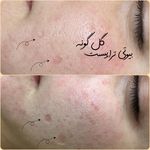 پاکسازی پوست اراک
