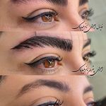 میکرو بلیدینگ و فیبروز متین