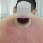 طب سنتی عامری (حجامت و بادکش)