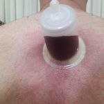 طب سنتی عامری (حجامت و بادکش)