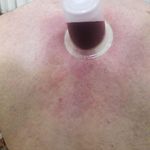 طب سنتی عامری (حجامت و بادکش)