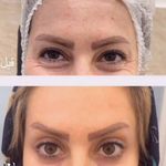 بوتاکس صورت توسط مژگان