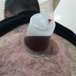 طب سنتی عامری (حجامت و بادکش)