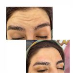 بوتاکس صورت توسط مژگان