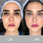 بوتاکس صورت توسط مژگان