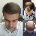 کلینیک تخصصی کاشت مو وابرو خبازی