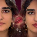 پوست مو فیلر جوانساز دکتر شاه نعمت الهی