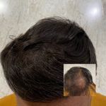 موسسه آموزش و درمان انواع ریزش مو ریشه