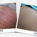 پاکسازی و آبرسانی صورت(فیشال)