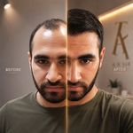 کاشت مو و ابرو