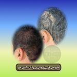 موسسه آموزش و درمان انواع ریزش مو ریشه