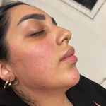 آفر ۹۰ درصدی ژل و بوتاکس و پی آر پی‌ و نخ