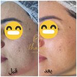 فیشال و پاکسازی پوست درنواب