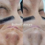 فیشال و پاکسازی تخصصی پوست سولماز
