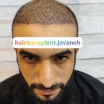 کاشت مو جوانه