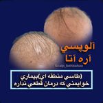موسسه آموزش و درمان انواع ریزش مو ریشه