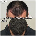 کلینیک تخصصی کاشت موی پرنیان