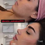 تزریق ژل و بوتاکس .انزیم