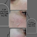 فیشیال و پاکسازی پوست مریم