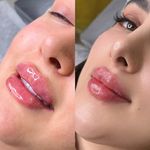 پاکسازی و فیشال تخصصی پوست جنابی