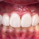 دندانپزشکی دکتر کاتبی کامپوزیت لمینیت