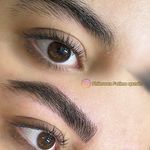 میکروبلیدینگ و فیبروز