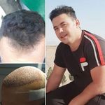 کلینیک تخصصی کاشت مو وابرو خبازی