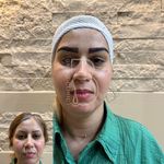 کلینیک کاشت مو باراد تهران