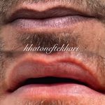 درمان تیرگی لب به روش دارک لیپس