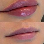 تزریق ژل و بوتاکس عبداله کوخی