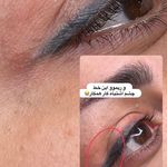 مرکز زیبایی عاطفه ترابی؛ فیبروز ابرو در اصفهان
