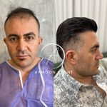 تخفیف ویژه بوتاکس پی ار پی مزوتراپی مزوژل لوکسیوا