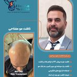 کاشت مو مفتاحی