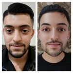 تزریق بوتاکس و ژل کانتور کامل صورت نصری