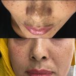 خدمات پوست و مو ( فیشیال)