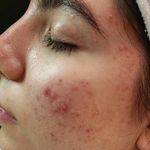 فیشال درمانی و پاکسازی پوست میرجلیلی