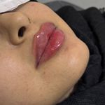 خانه لیزر فیلر و بوتاکس ثنا