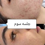 خدمات تخصصی فشیال و پاکسازی صورت سحر