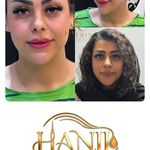 کلینیک هانیل | فیلر و بوتاکس شرق