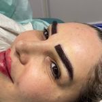 کاشت ابروی هیلدا