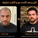 کاشت مو شیراز و کاشت شقیقه صادق نیا