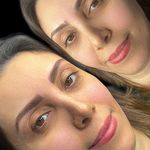 میکروبلیدینگ و فیبروز المیرا