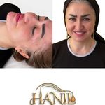 کلینیک هانیل | فیلر و بوتاکس شرق